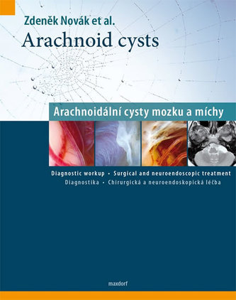 Arachnoidální cysty mozku a míchy