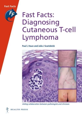 Fast Facts: Diagnosing Cutaneous T-cell Lymphoma