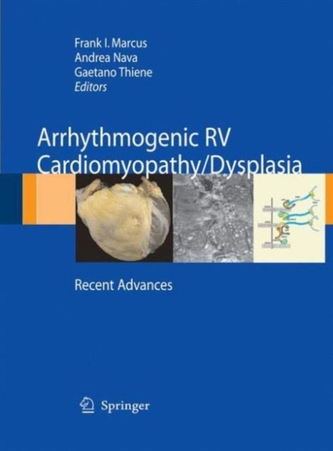 Arrhythmogenic RV Cardiomyopathy/Dysplasia
