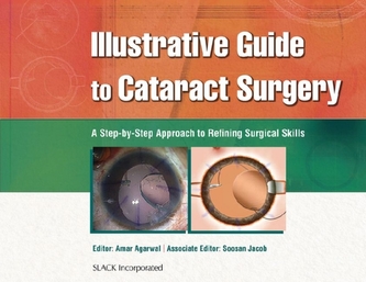 Illustrative Guide to Cataract Surgery