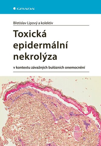 Toxická epidermální nekrolýza
