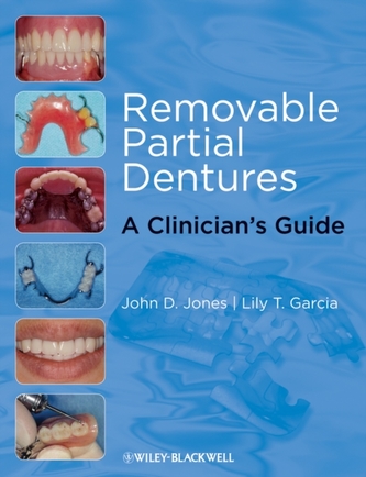 Removable Partial Dentures Removable Partial Dentures