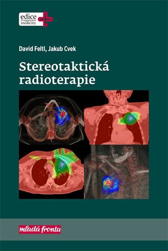 Stereotaktická radioterapie (Jakub Cvek, 2019)