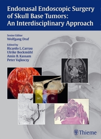 Endonasal Endoscopic Surgery of Skull Base Tumors Endonasal Endoscopic Surgery of Skull Base Tumors