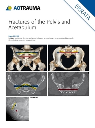 Fractures of the Pelvis and Acetabulum