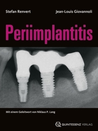 Periimplantitis