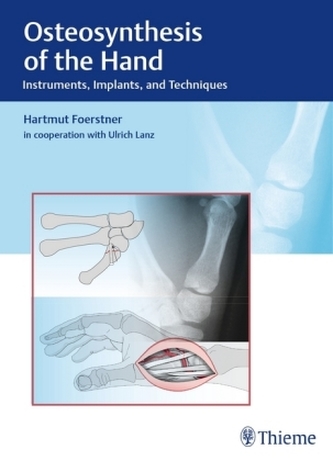 Osteosynthesis of the Hand Osteosynthesis of the Hand