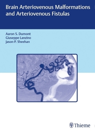 Brain Arteriovenous Malformations and Arteriovenous Fistulas Brain Arteriovenous Malformations and Arteriovenous Fistulas