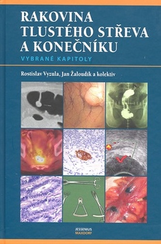 Rakovina tlustého střeva a konečníku - Rostislav Vyzula