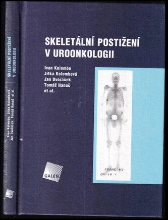 Skeletální postižení v uroonkologii (Ivan Kolombo, 2005)